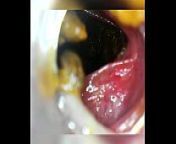 Endoscope withdraw after deep insertion from endoscope creampie