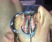 Cuming on Headgear braces from indian lover fuck forest